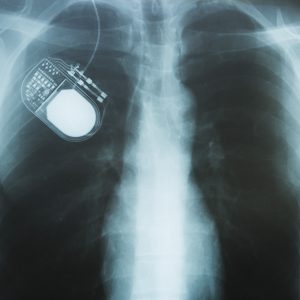 Νευροδιεγέρτες DBS, η επανάσταση στην νόσο Πάρκινσον