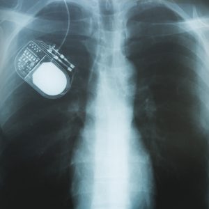 Νευροδιεγέρτης – DBS σε άλλα νοσήματα